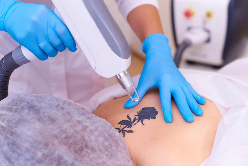 Is Laser Tattoo Removal Safe?